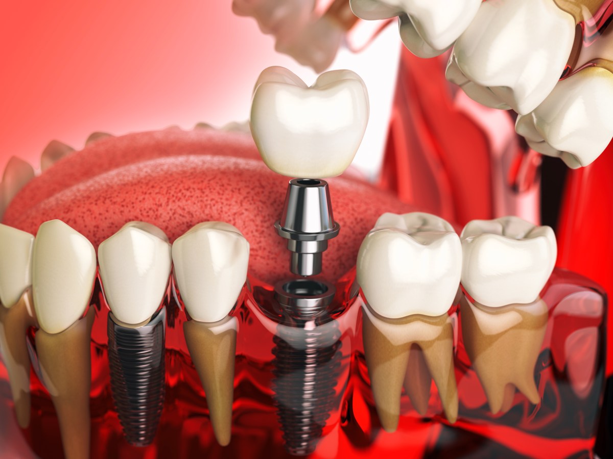 Wstawianie implantów zębowych